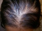 Hair Thinning Concerns - Explore Causes Before Buying Treatments