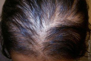 Hair Thinning Concerns - Explore Causes Before Buying Treatments