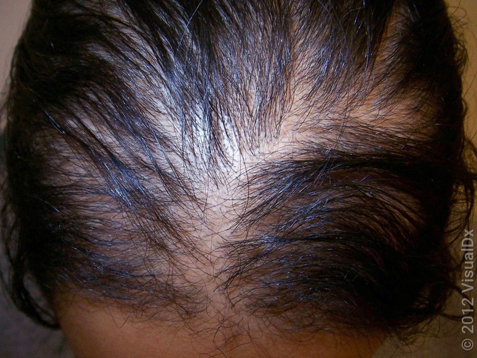 Hair Thinning Concerns - Explore Causes Before Buying Treatments